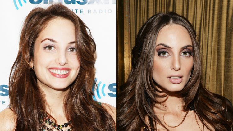 Photo of Alexa Ray Joel Before And After Rhinoplasty 