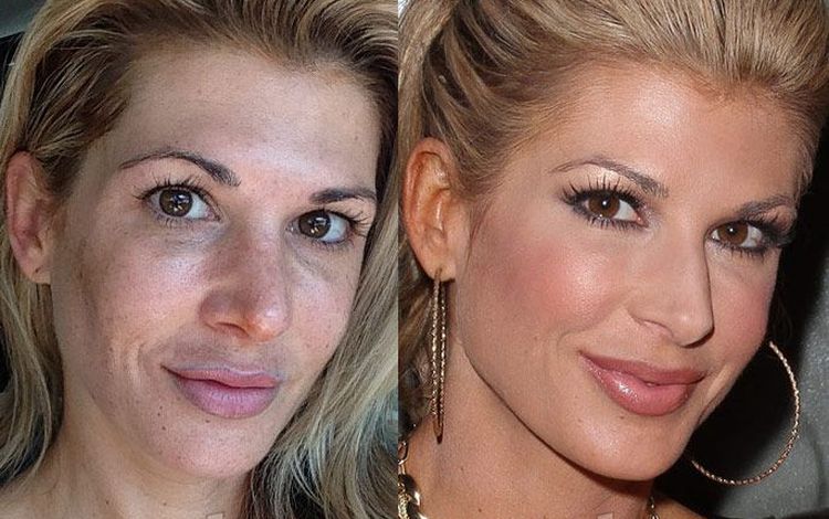 Photo of Alexis Bellino Before And After Rhinoplasty 