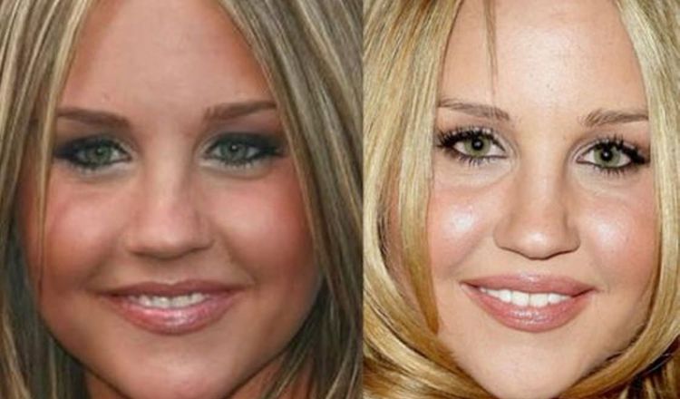 Photo of Amanda Bynes Before And After Rhinoplasty 