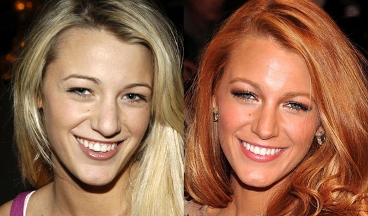 Photo of Blake Lively Before And After Rhinoplasty 