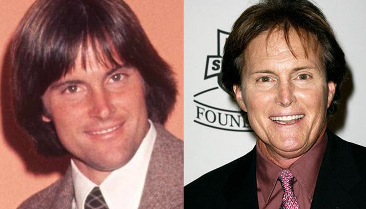 Photo of Bruce/Caitlyn Jener Before And After Rhinoplasty 