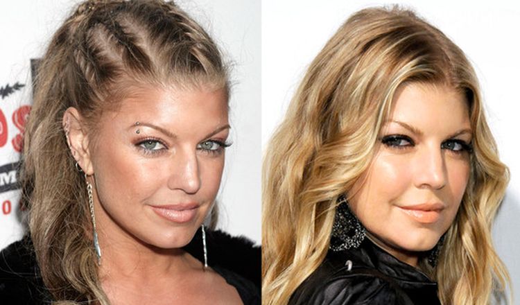 Photo of Fergie Before And After Rhinoplasty 