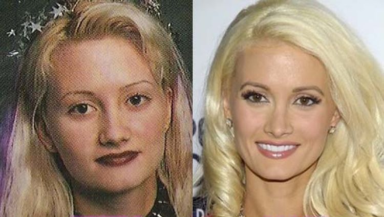 Photo of Holly Madison Before And After Rhinoplasty 