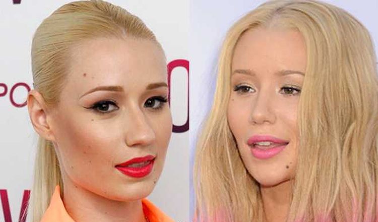 Photo of Iggy Azalea Before And After Rhinoplasty 