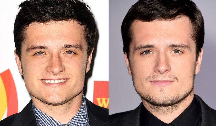 Photo of Josh Hutcherson Before And After Rhinoplasty 