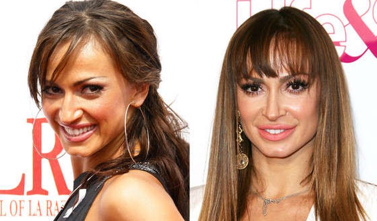 Photo of Karina Smirnoff Before And After Rhinoplasty 