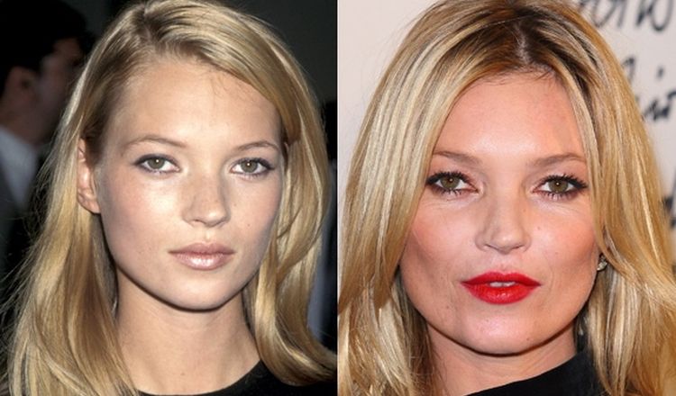 Photo of Kate Moss Before And After Rhinoplasty 