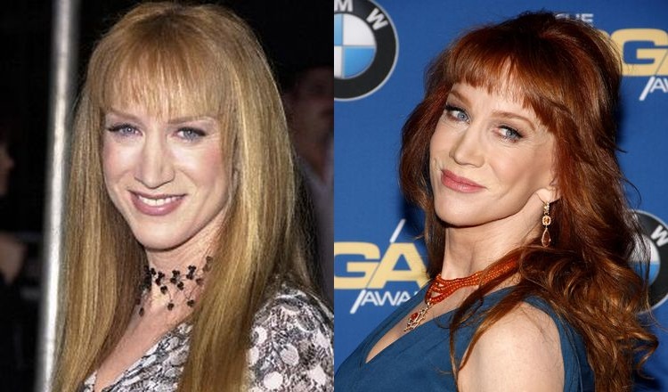 Photo of Kathy Griffin Before And After Rhinoplasty 