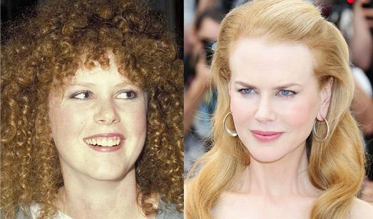 Photo of Nicole Kidman Before And After Rhinoplasty 