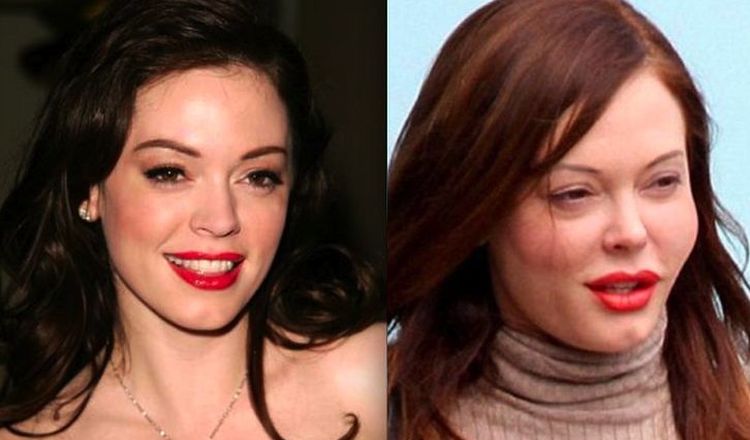 Photo of Rose McGowan Before And After Rhinoplasty 