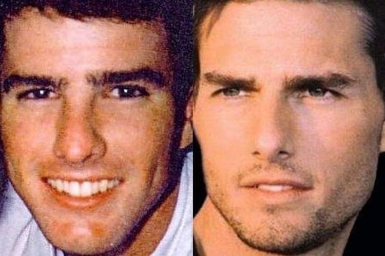 Photo of Tom Cruise Before And After Rhinoplasty 