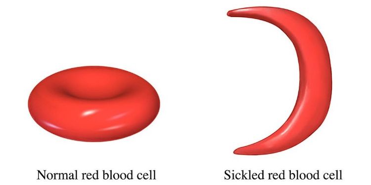 image of Anemia cell