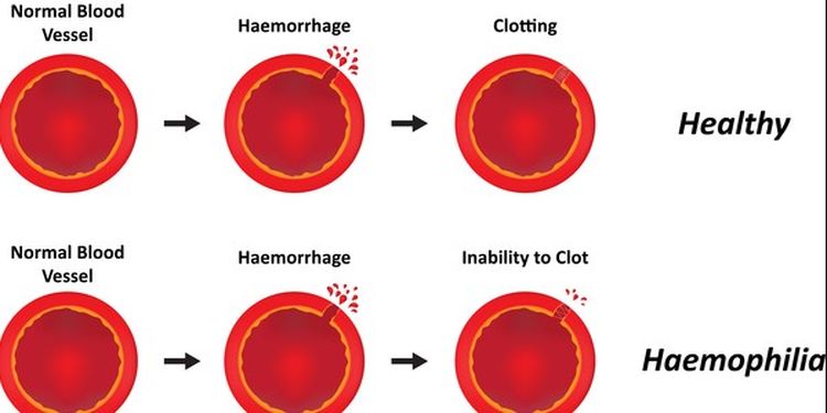 image of hemophilia