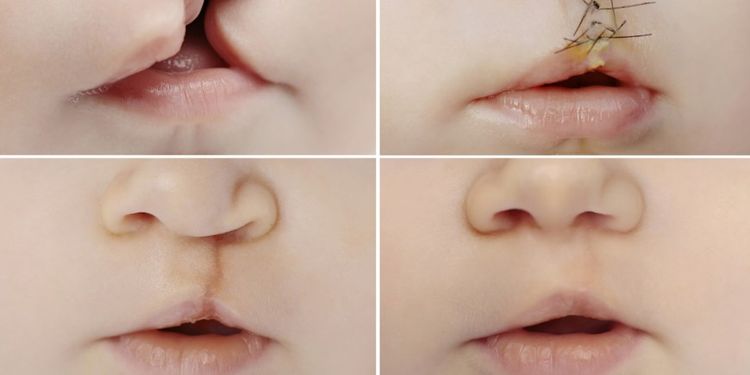 image of cleft lip