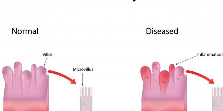 Image of irritable bowel syndrome