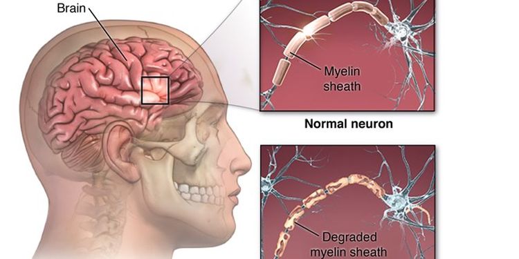 Multiple Sclerosis