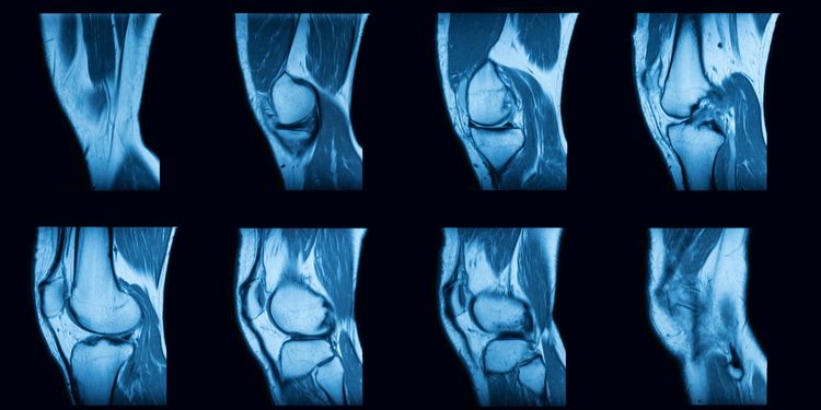 MRI Knee Scan