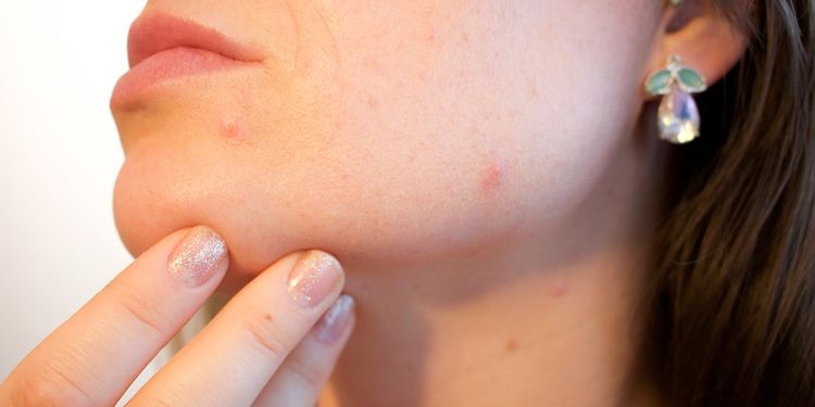 Photo of female face with acne