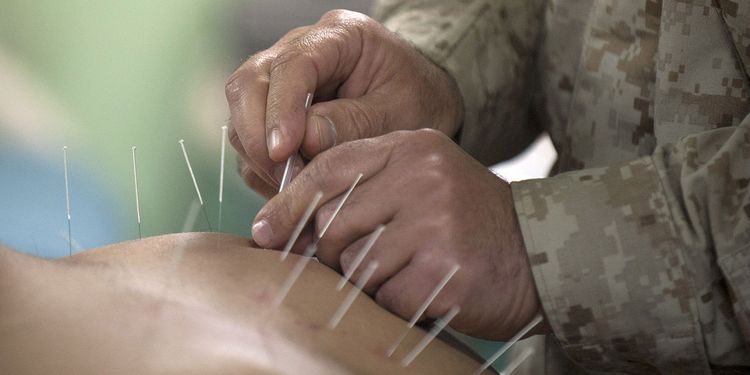 Photo of US officer conducting acupuncture treatment