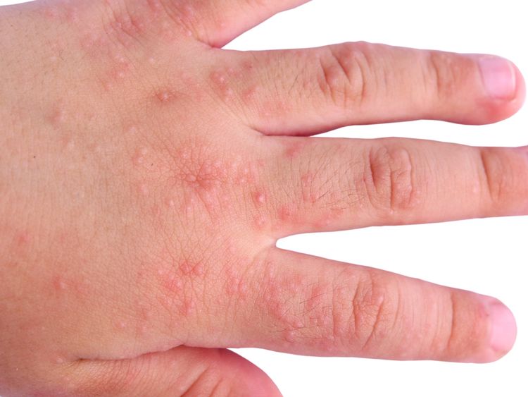 Photo of a hand with Allergic Rash Dermatitis