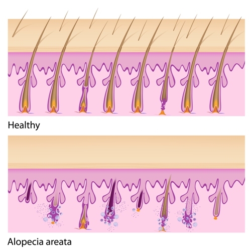 Hair Loss Alopecia Areata