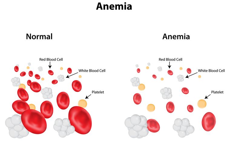 Illustration of anemic red blood cells