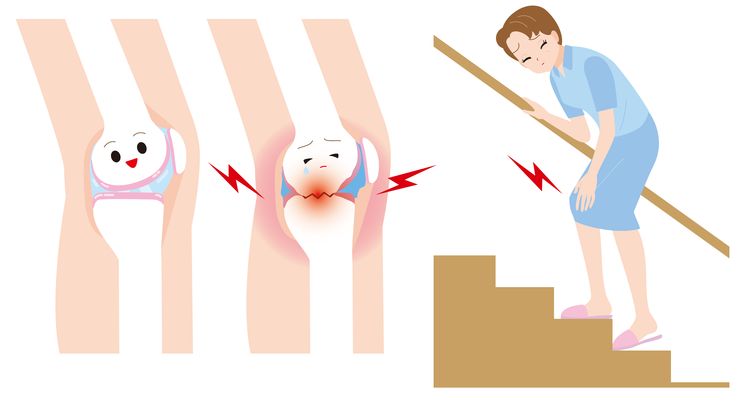 Illustration of woman to climb the stairs with pain and cartoonish knee joints