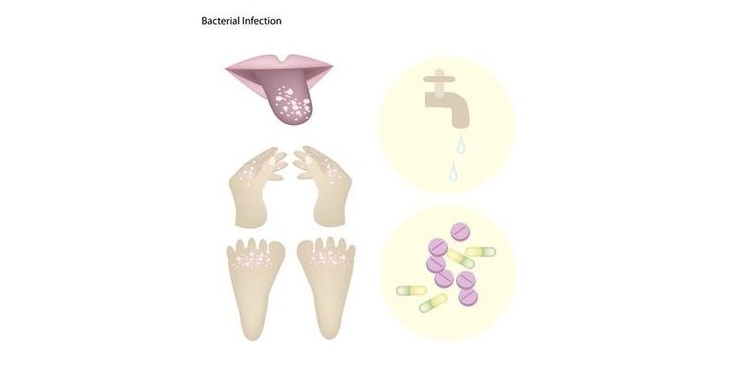 Illustration of Candidiasis Symptoms on a tongue and skin