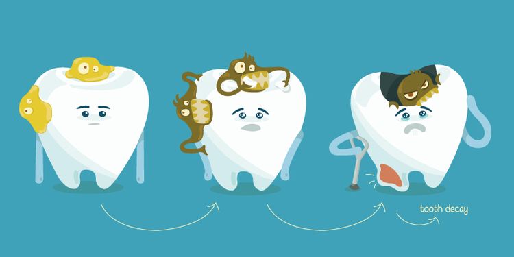 Drawing of tooth decay step by step