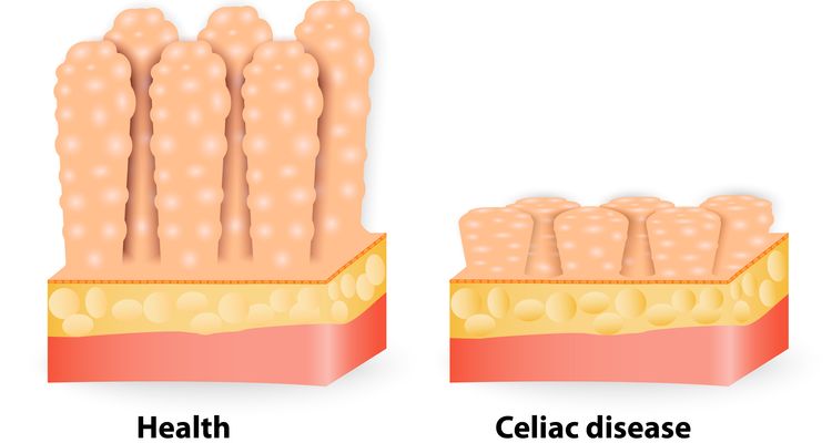 Illustration of a healthy and celiac disease affected villi