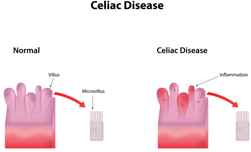 Illustration of Celiac Disease Food Sensitivity