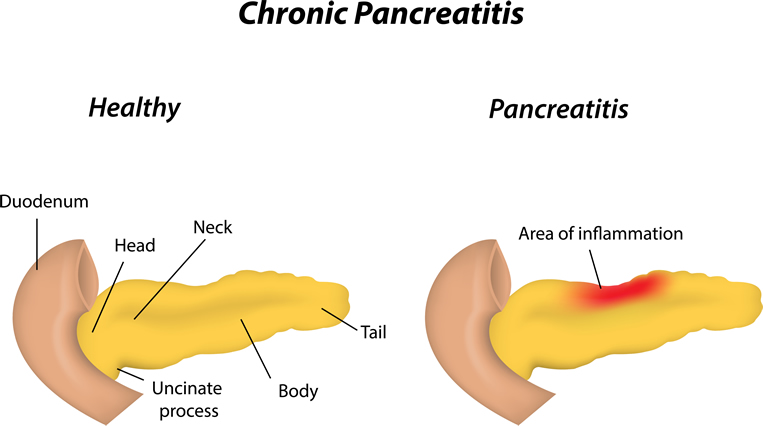 Chronic Pancreatitis