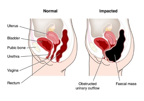 Constipated Bowel