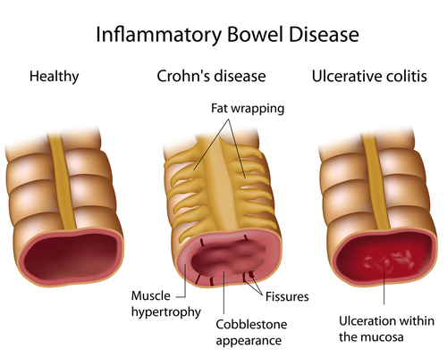 Chron's Disease Condition