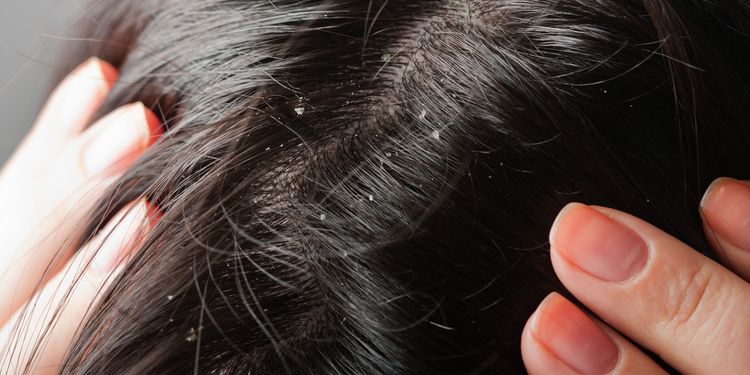 Photo of dandruff on head hair