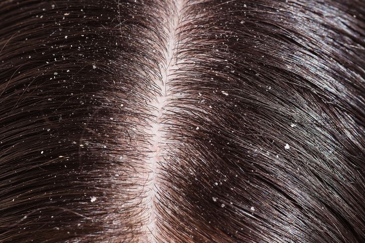 Photo of Dandruff on scalp