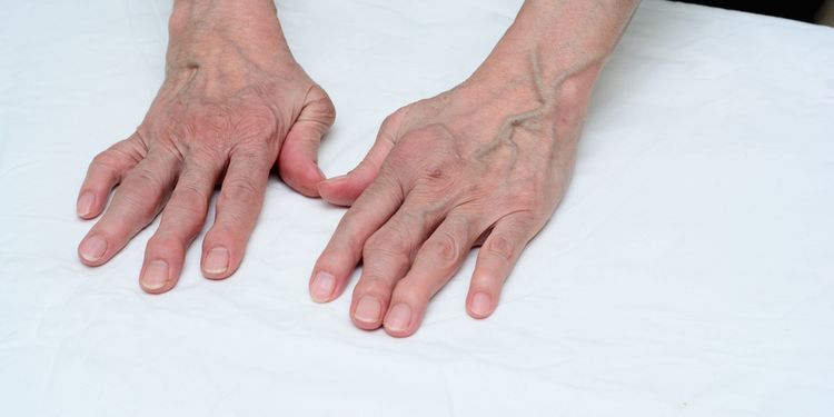 Photo of female hands with deformed finger joints