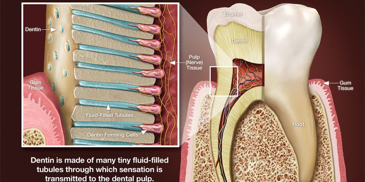Illustration of a tooth with enlarged dentinal tubules