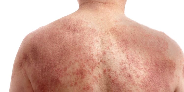 Photo of a naked human back with dermatitis rash