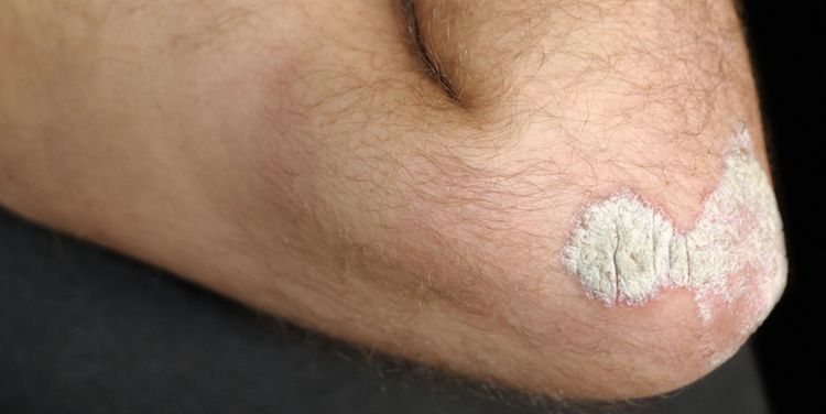 Photo of human elbow with symptoms of dry skin