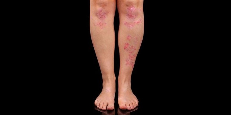 Photo of Dermatitis on leg skin