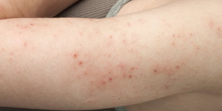 Photo of upper arm with atopic dermatitis symptoms