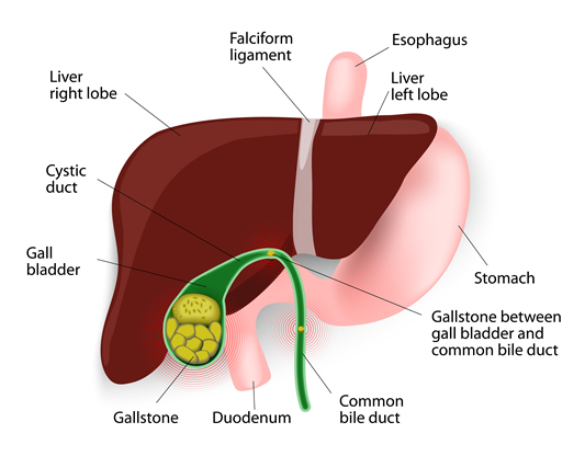 Gallstone Formation