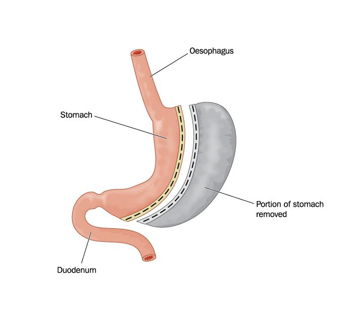 Illustation of bariatric surgery on Gastrointestinal Tract