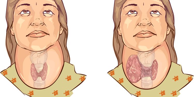 Image showing process of thyroid enlargement due to goiter