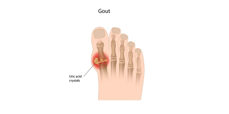 Illustration of a gout on feet