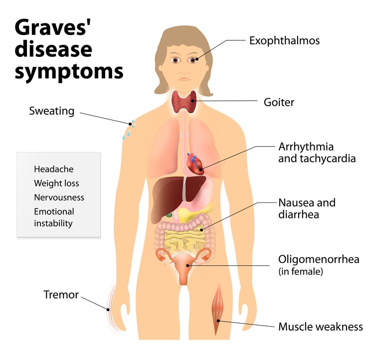 Diagram showing symptoms of Graves' disease