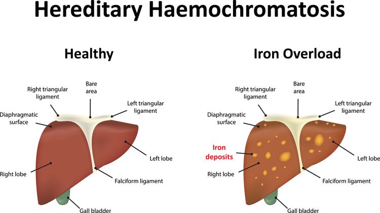 Illustration of a liver with haemochromatosis