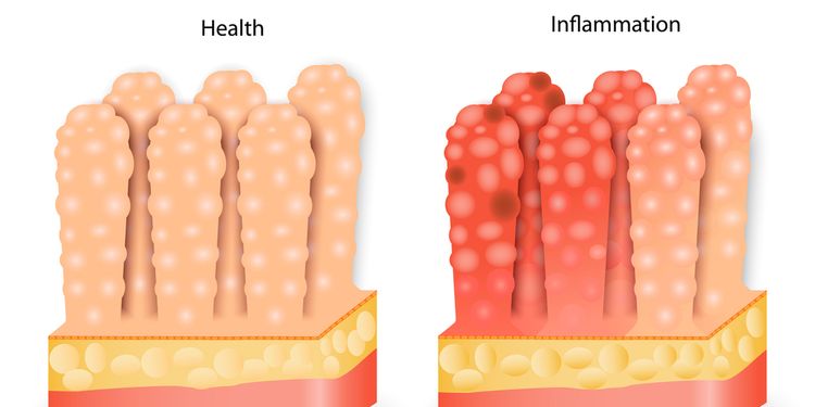 Image illustration of stomach villi, healthy and inflammed 