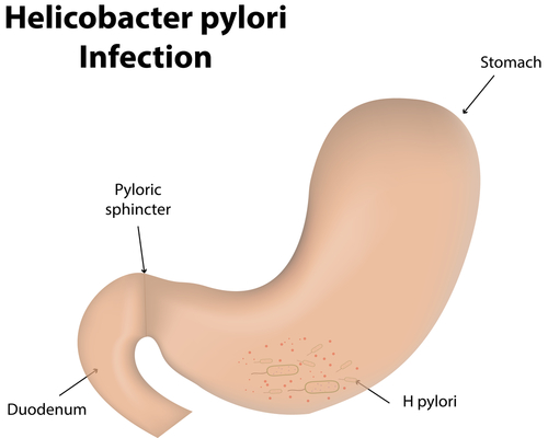 Illustration of Helicobacter Pylori Infection